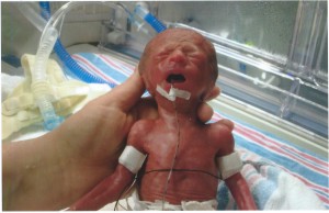25 week old preemie micropreemie